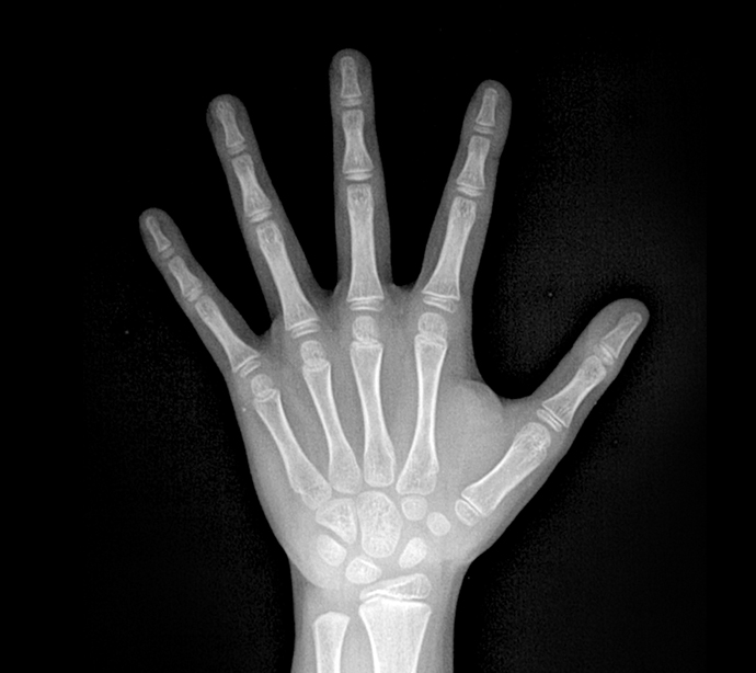 성장판 검사 엑스레이 촬영